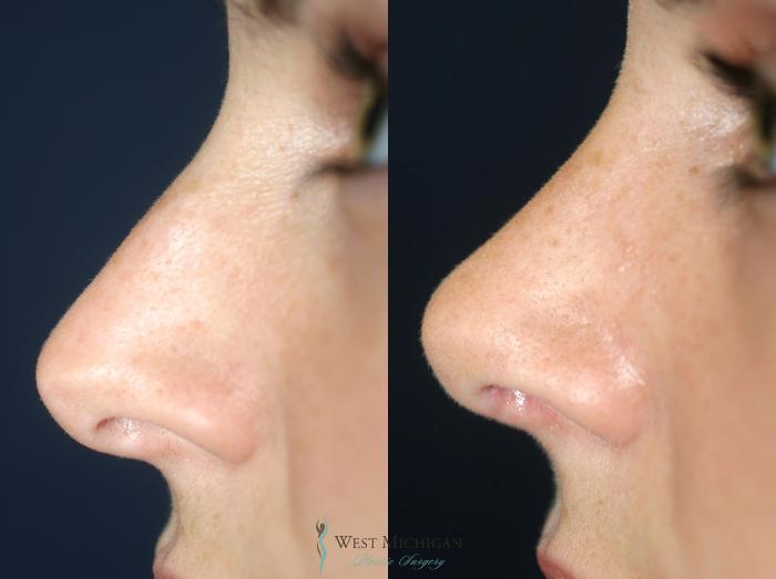 Before & After Nose Surgery Case 8893 View #1 View in Portage, Kalamazoo, Battle Creek, Michigan