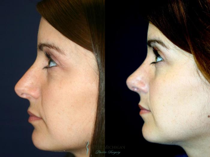Before & After Nose Surgery Case 8893 View #3 View in Portage, Kalamazoo, Battle Creek, Michigan