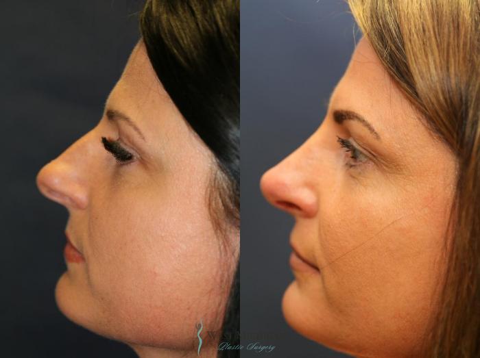 Before & After Nose Surgery Case 8894 View #2 View in Portage, Kalamazoo, Battle Creek, Michigan
