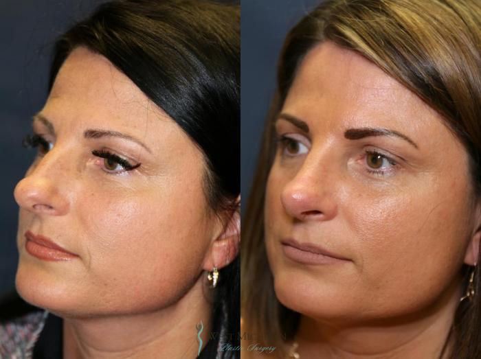 Before & After Nose Surgery Case 8894 View #3 View in Portage, Kalamazoo, Battle Creek, Michigan