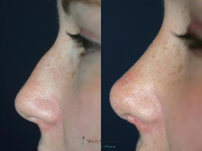 Before & After Nose Surgery Case 8895 View #2 View in Portage, Kalamazoo, Battle Creek, Michigan