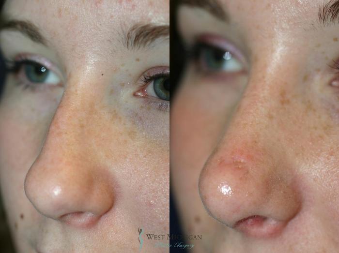 Before & After Nose Surgery Case 8895 View #3 View in Portage, Kalamazoo, Battle Creek, Michigan