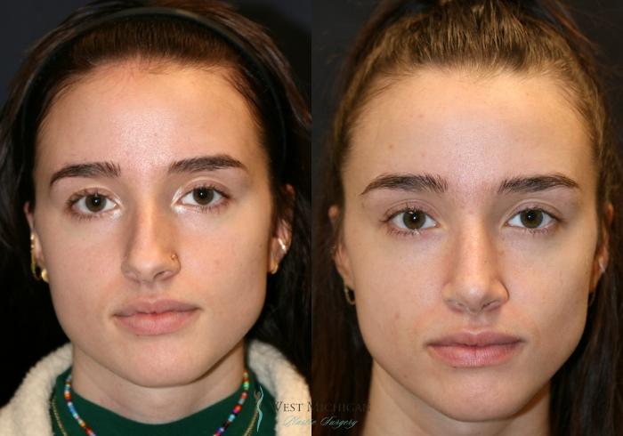 Before & After Nose Surgery Case 9349 Front View in Portage, Kalamazoo, Battle Creek, Michigan