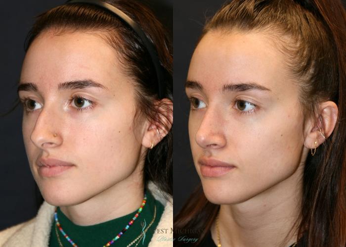 Before & After Nose Surgery Case 9349 Left Oblique View in Portage, Kalamazoo, Battle Creek, Michigan