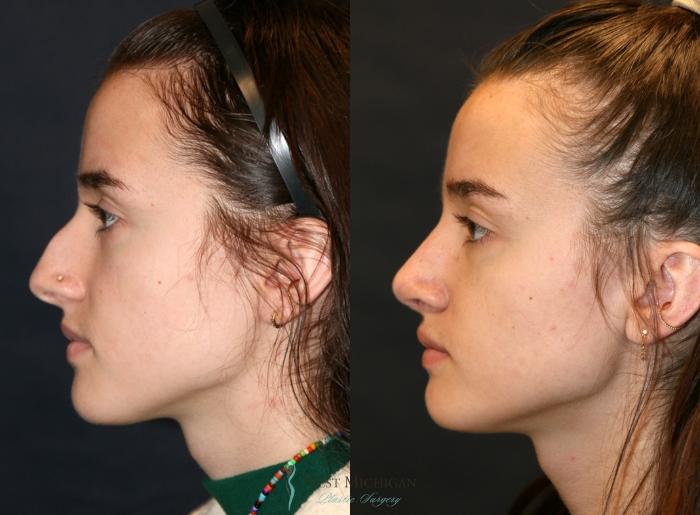 Before & After Nose Surgery Case 9349 Left Side View in Portage, Kalamazoo, Battle Creek, Michigan