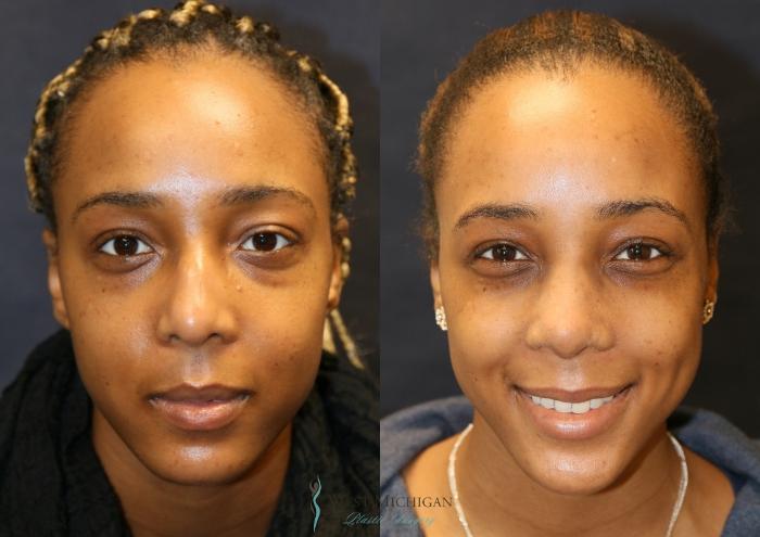 Before & After Nose Surgery Case 9361 Front View in Portage, Kalamazoo, Battle Creek, Michigan