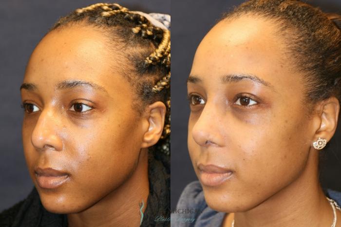 Before & After Nose Surgery Case 9361 Left Oblique View in Portage, Kalamazoo, Battle Creek, Michigan