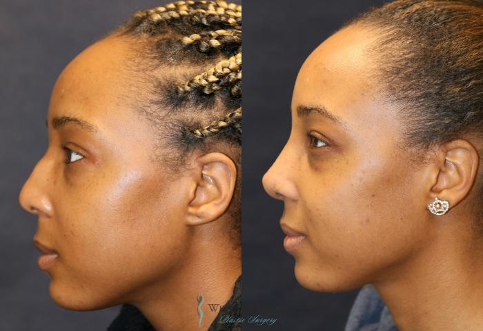 Before & After Nose Surgery Case 9361 Left Side View in Portage, Kalamazoo, Battle Creek, Michigan