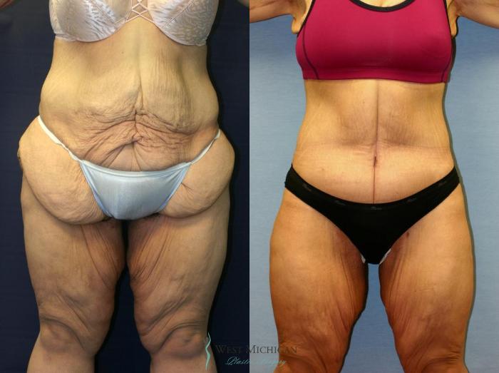 Before & After Post Weight Loss Case 8710 View #1 View in Kalamazoo & Grand Rapids, Michigan