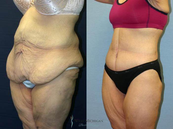 Before & After Post Weight Loss Case 8710 View #3 View in Portage, Kalamazoo, Battle Creek, Michigan