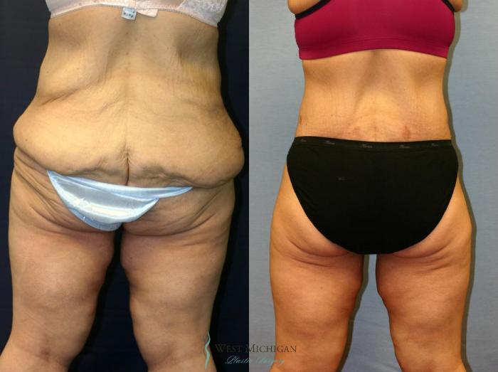 Before & After Post Weight Loss Case 8710 View #4 View in Portage, Kalamazoo, Battle Creek, Michigan