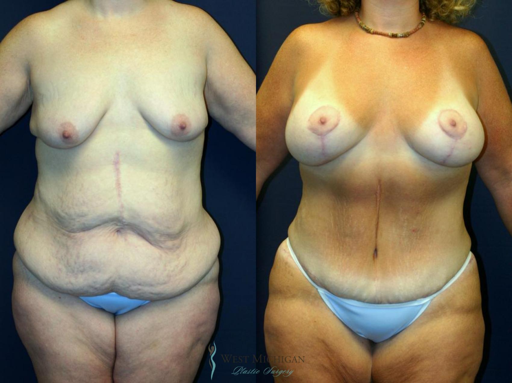 Before & After Post Weight Loss Case 8711 View #1 View in Kalamazoo & Grand Rapids, Michigan