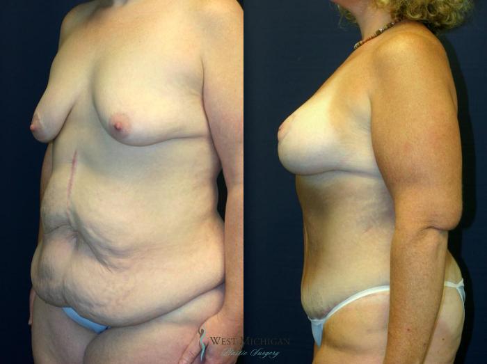 Before & After Post Weight Loss Case 8711 View #2 View in Kalamazoo & Grand Rapids, Michigan