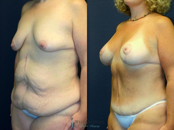 Before & After Post Weight Loss Case 8711 View #3 View in Kalamazoo & Grand Rapids, Michigan