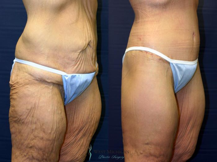 Before & After Post Weight Loss Case 8712 View #3 View in Kalamazoo & Grand Rapids, Michigan
