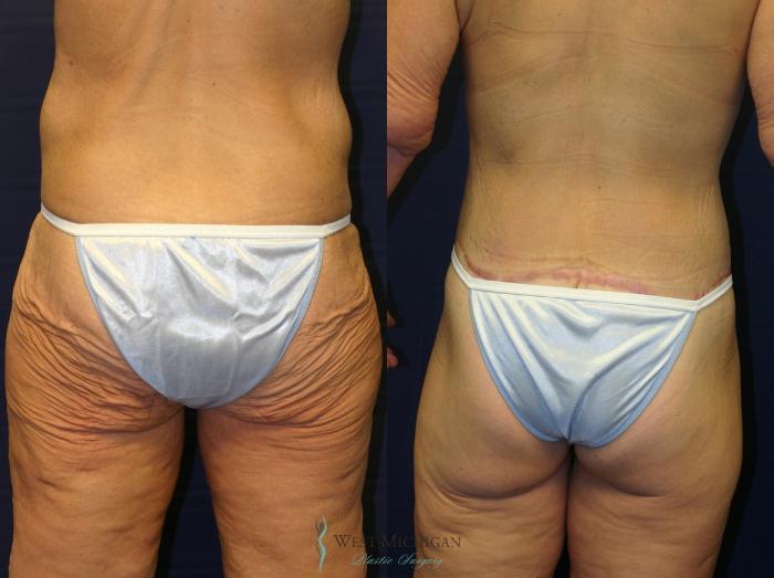 Before & After Post Weight Loss Case 8712 View #4 View in Kalamazoo & Grand Rapids, Michigan