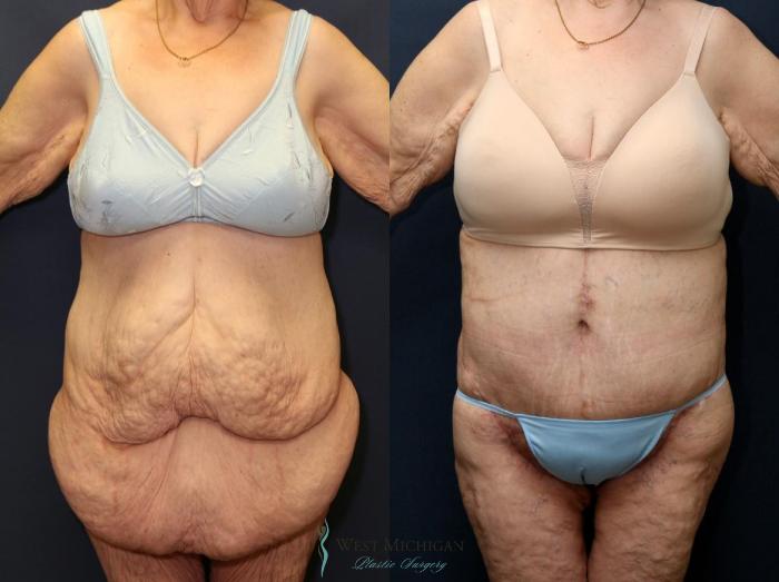 Before & After Post Weight Loss Case 8963 View #1 View in Portage, Kalamazoo, Battle Creek, Michigan