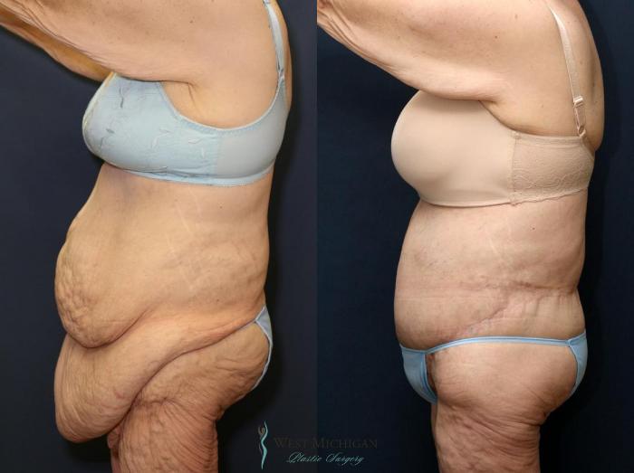 Before & After Post Weight Loss Case 8963 View #2 View in Portage, Kalamazoo, Battle Creek, Michigan