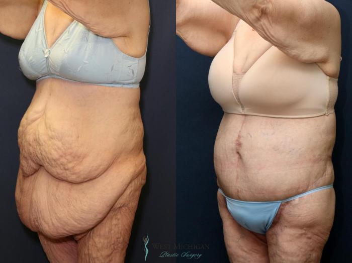 Before & After Post Weight Loss Case 8963 View #3 View in Portage, Kalamazoo, Battle Creek, Michigan