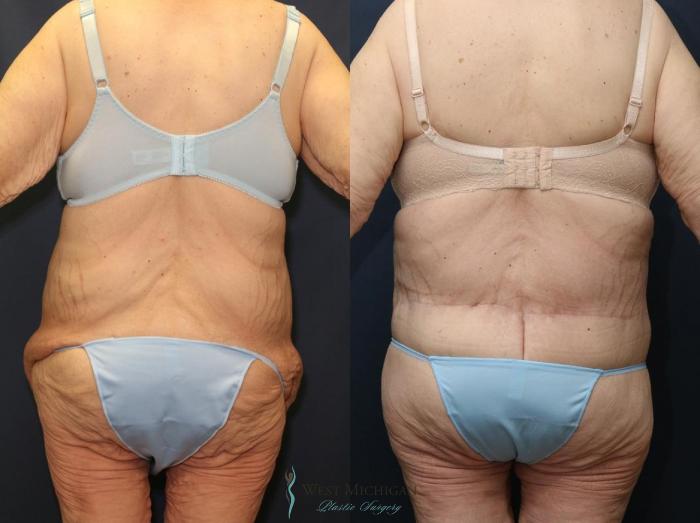 Before & After Post Weight Loss Case 8963 View #4 View in Portage, Kalamazoo, Battle Creek, Michigan