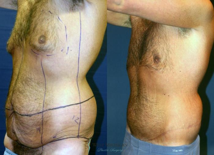 Before & After Post Weight Loss Case 8964 View #3 View in Kalamazoo & Grand Rapids, Michigan
