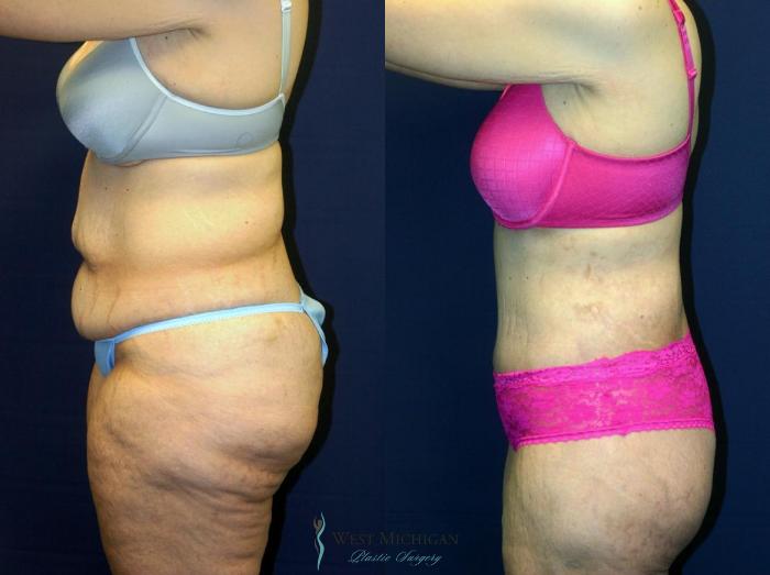 Before & After Post Weight Loss Case 8965 View #2 View in Portage, Kalamazoo, Battle Creek, Michigan
