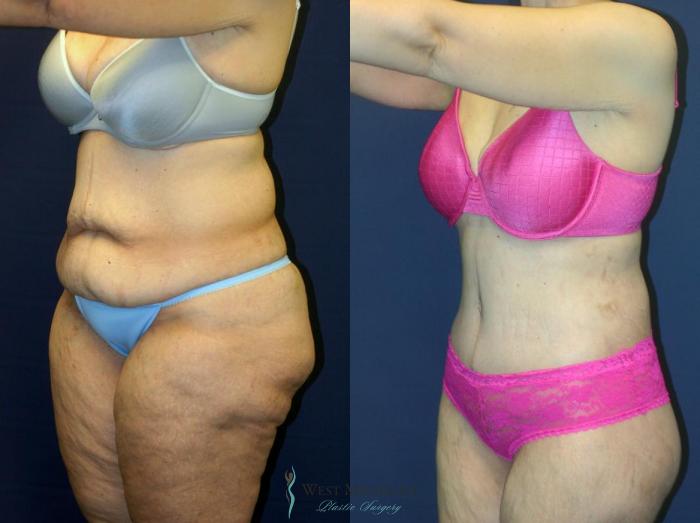 Before & After Post Weight Loss Case 8965 View #3 View in Portage, Kalamazoo, Battle Creek, Michigan