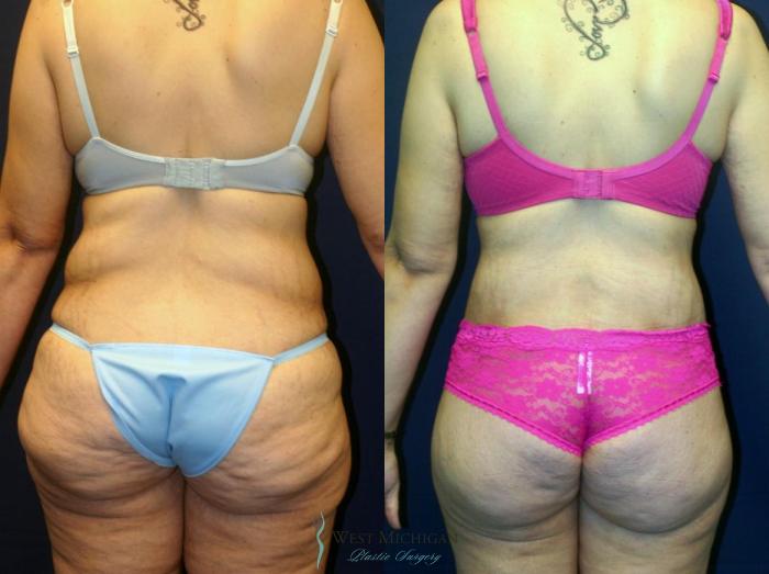Before & After Post Weight Loss Case 8965 View #4 View in Portage, Kalamazoo, Battle Creek, Michigan