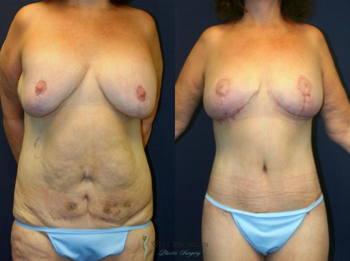 Before & After Post Weight Loss Case 8967 View #1 View in Kalamazoo & Grand Rapids, Michigan