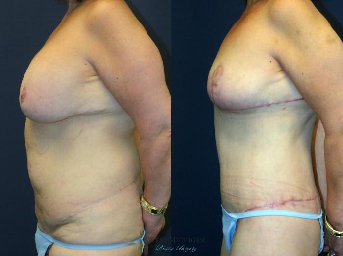 Before & After Post Weight Loss Case 8967 View #2 View in Kalamazoo & Grand Rapids, Michigan