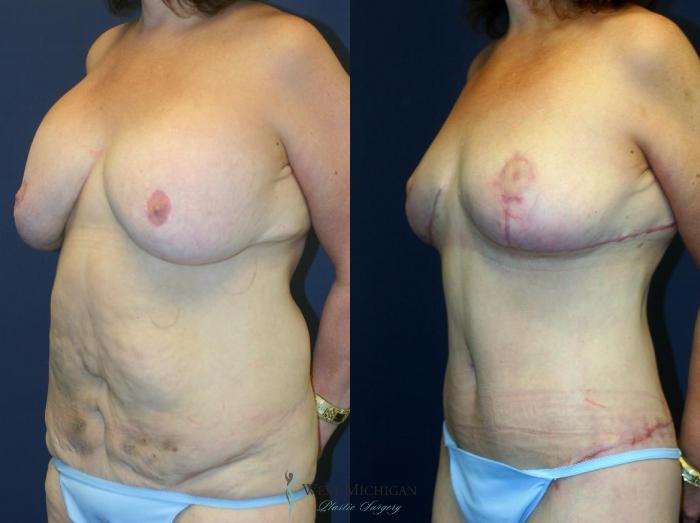 Before & After Post Weight Loss Case 8967 View #3 View in Kalamazoo & Grand Rapids, Michigan