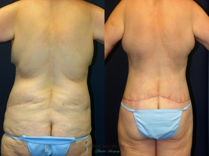 Before & After Post Weight Loss Case 8967 View #4 View in Kalamazoo & Grand Rapids, Michigan
