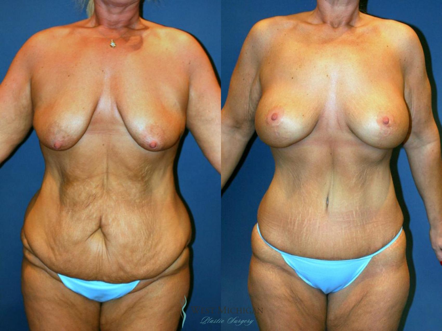 Before & After Post Weight Loss Case 9038 View #1 View in Kalamazoo & Grand Rapids, Michigan