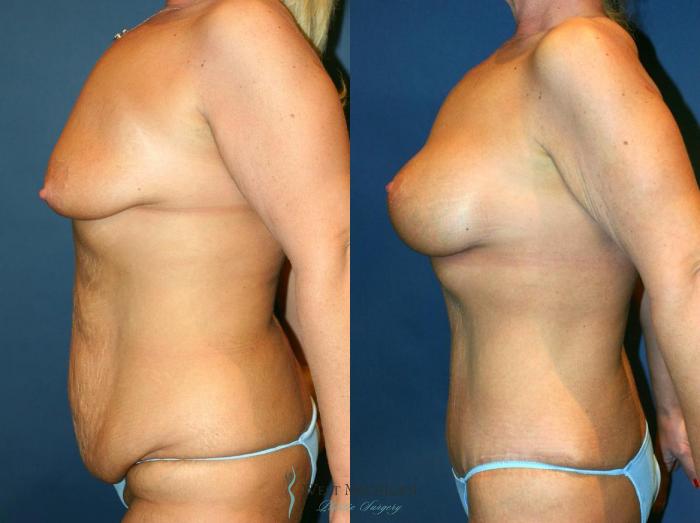 Before & After Post Weight Loss Case 9038 View #2 View in Kalamazoo & Grand Rapids, Michigan
