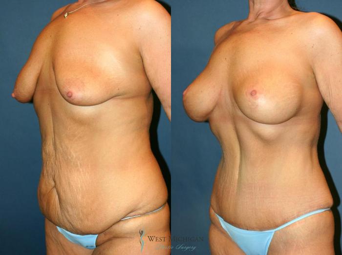 Before & After Post Weight Loss Case 9038 View #3 View in Kalamazoo & Grand Rapids, Michigan