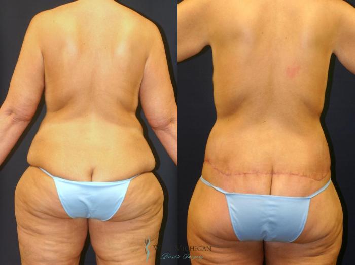 Before & After Post Weight Loss Case 9041 View #2 View in Kalamazoo & Grand Rapids, Michigan