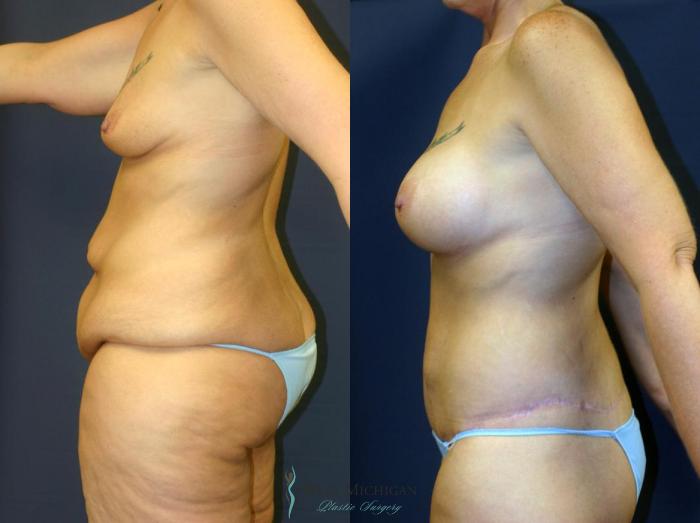 Before & After Post Weight Loss Case 9041 View #3 View in Kalamazoo & Grand Rapids, Michigan