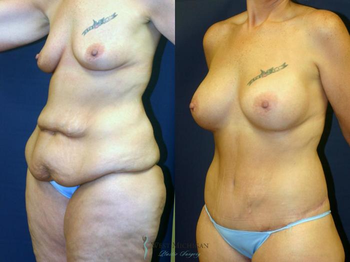 Before & After Post Weight Loss Case 9041 View #4 View in Kalamazoo & Grand Rapids, Michigan