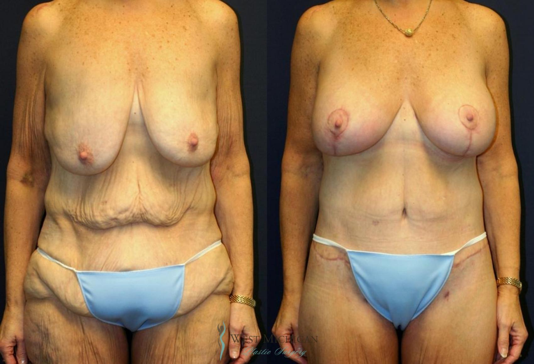 Before & After Post Weight Loss Case 9042 View #1 View in Kalamazoo & Grand Rapids, Michigan