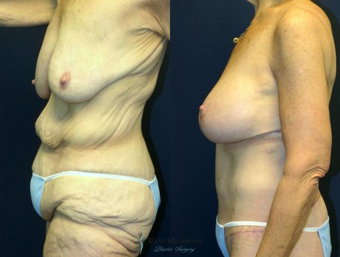 Before & After Post Weight Loss Case 9042 View #3 View in Kalamazoo & Grand Rapids, Michigan