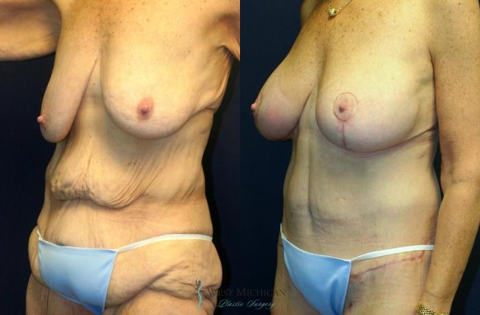 Before & After Post Weight Loss Case 9042 View #4 View in Kalamazoo & Grand Rapids, Michigan