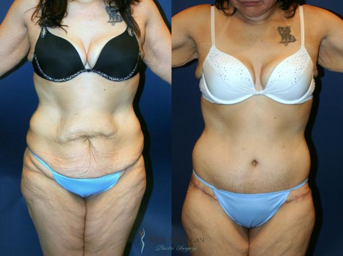 Before & After Post Weight Loss Case 9045 View #1 View in Kalamazoo & Grand Rapids, Michigan