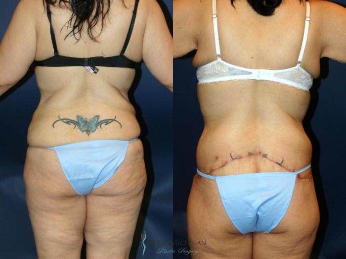 Before & After Post Weight Loss Case 9045 View #2 View in Kalamazoo & Grand Rapids, Michigan