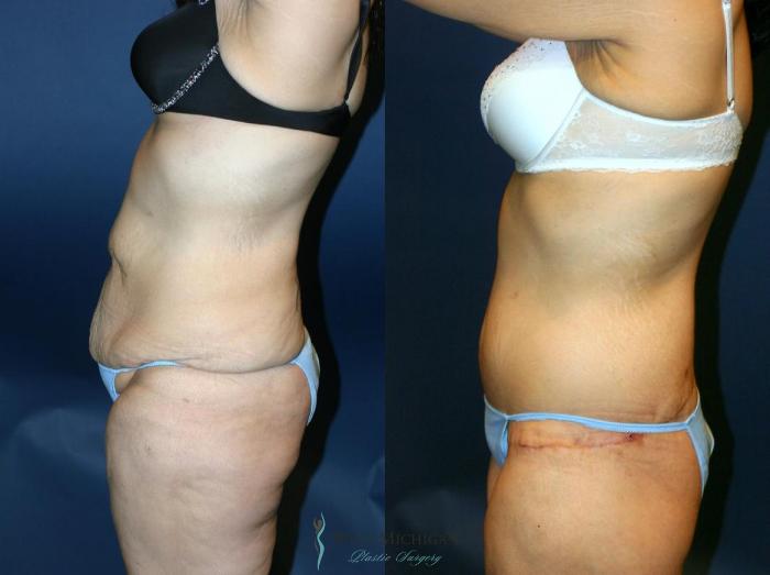 Before & After Post Weight Loss Case 9045 View #3 View in Kalamazoo & Grand Rapids, Michigan