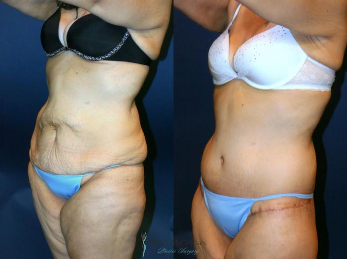 Before & After Post Weight Loss Case 9045 View #4 View in Kalamazoo & Grand Rapids, Michigan