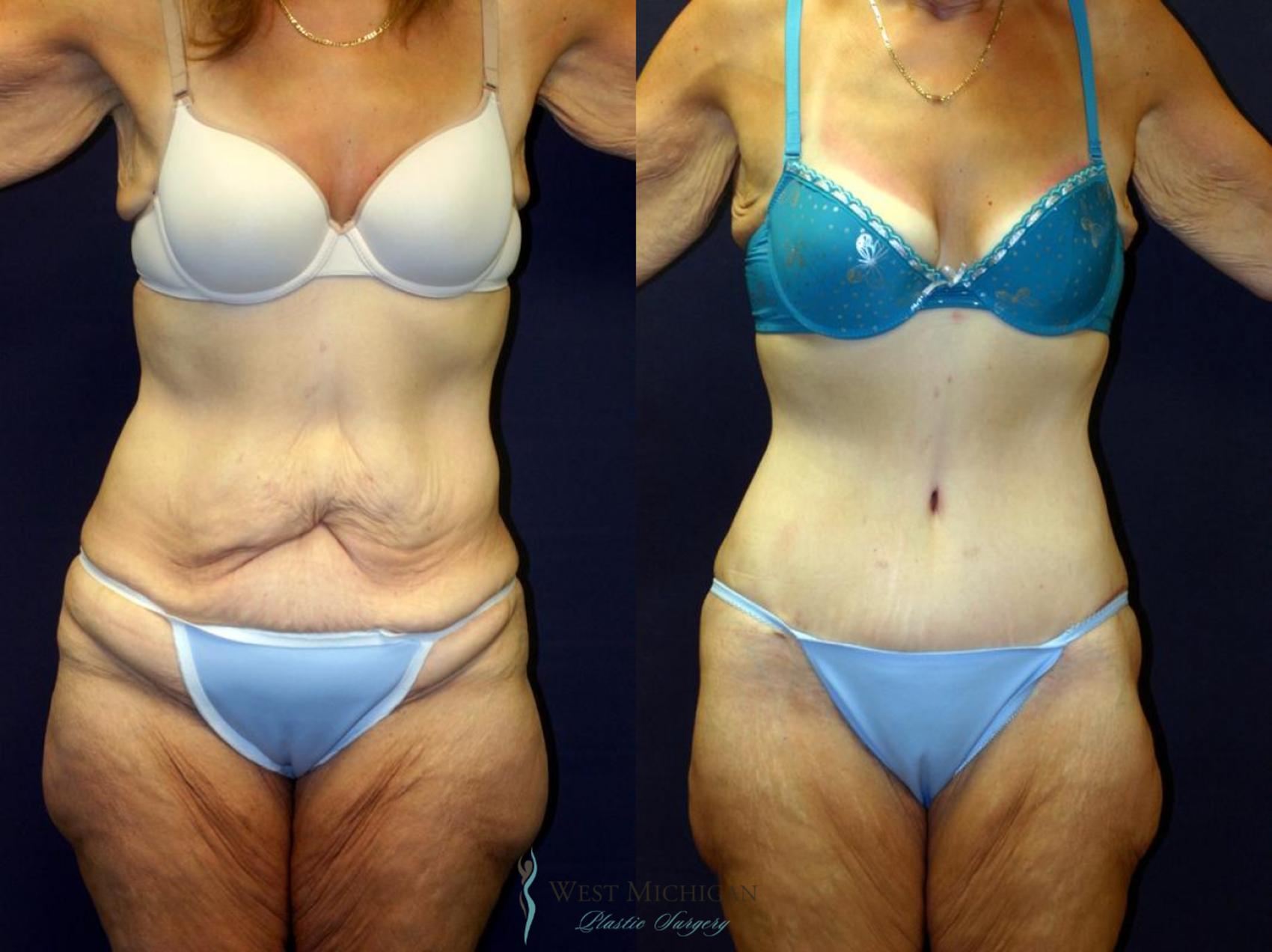 Before & After Post Weight Loss Case 9046 View #1 View in Kalamazoo & Grand Rapids, Michigan