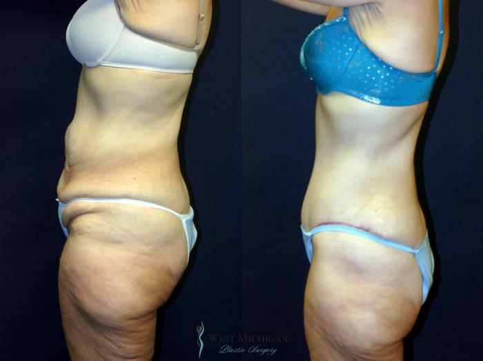Before & After Post Weight Loss Case 9046 View #2 View in Kalamazoo & Grand Rapids, Michigan