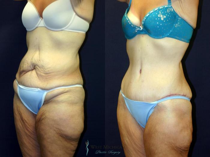 Before & After Post Weight Loss Case 9046 View #3 View in Kalamazoo & Grand Rapids, Michigan