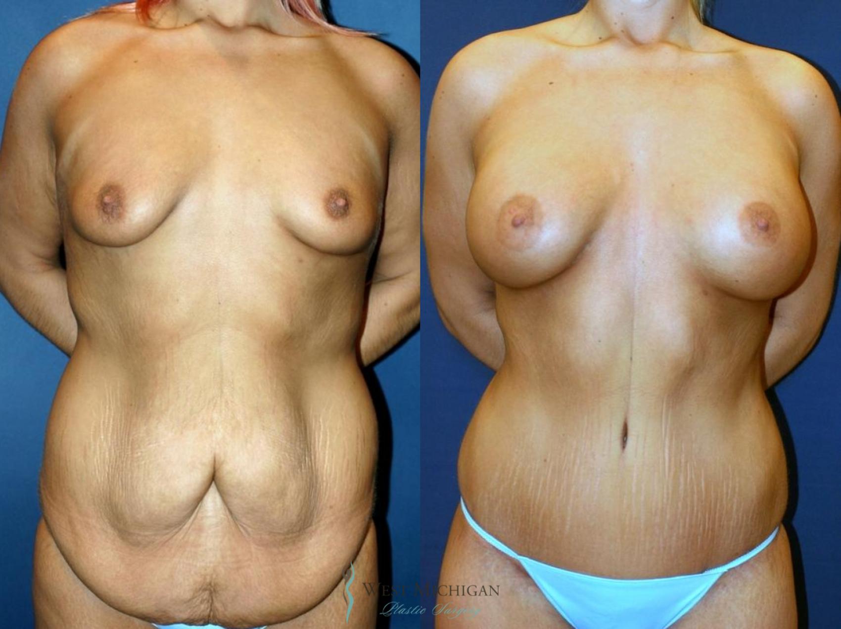 Before & After Post Weight Loss Case 9047 View #1 View in Kalamazoo & Grand Rapids, Michigan