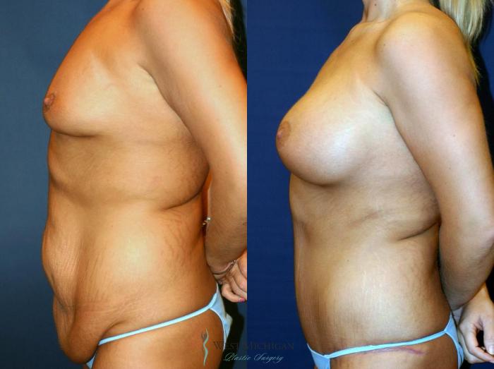 Before & After Post Weight Loss Case 9047 View #2 View in Kalamazoo & Grand Rapids, Michigan